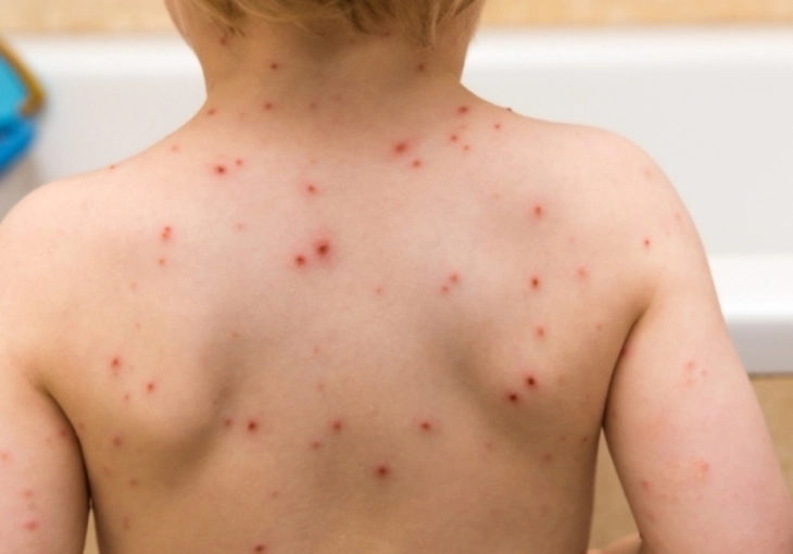 Нискиот опфат со МРП-вакцината е ризик од епидемија на мали сипаници, предупредуваат лекарите