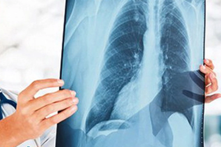 Бројот на случаи со туберкулоза кај нас континуирано опаѓа, но болеста се уште е присутна