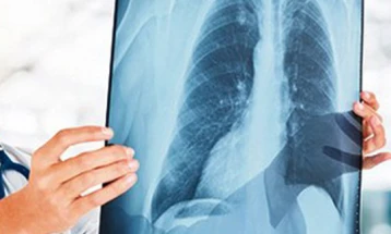 Бројот на случаи со туберкулоза кај нас континуирано опаѓа, но болеста се уште е присутна