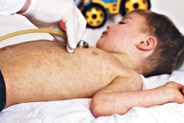 Во Белград пријавена епидемија на мали сипаници