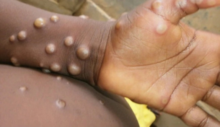 WHO to convene emergency panel over mpox strain spreading in Africa