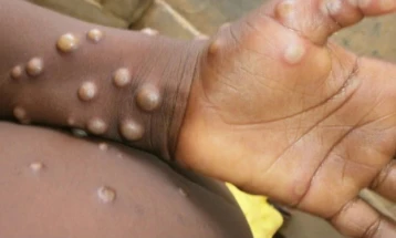 WHO to convene emergency panel over mpox strain spreading in Africa