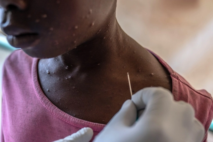 Mpox spreads to Zambia and Ghana, with 16 countries now affected