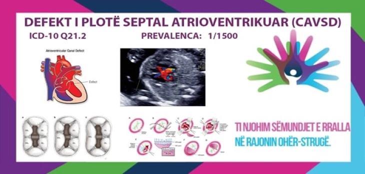 I njohim sëmundjet e rralla - DEFEKT I PLOTË SEPTAL ATRIOVENTRIKUAR (KAVSD)