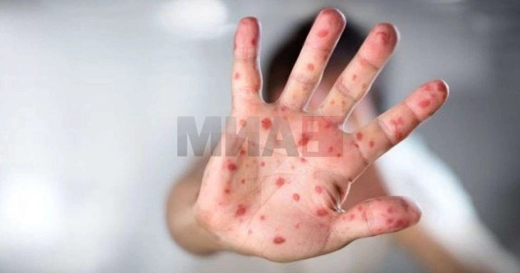 Две девојчиња во Тексас починаа од сипаници, верска заедница одбива вакцини