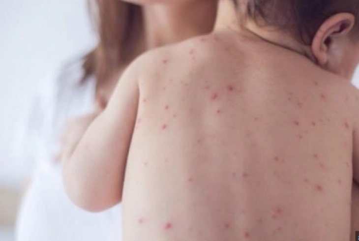 СЗО и УНИЦЕФ: Опаѓањето на стапката на вакцинација предизвикува раст на болести што можат да се спречат