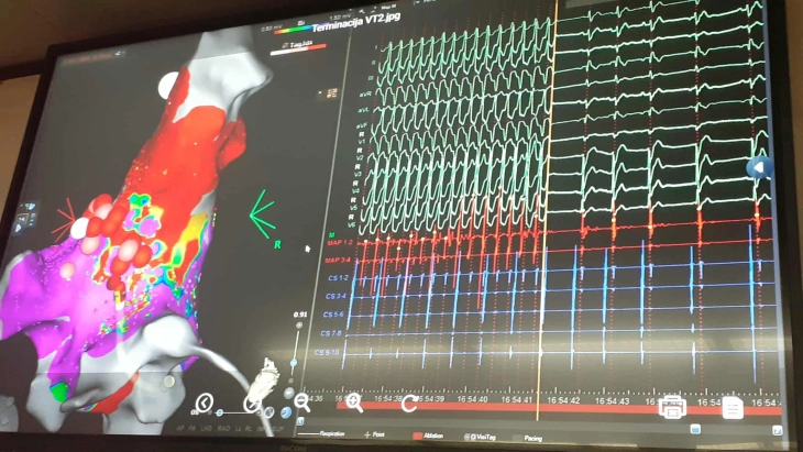 Воведена нова процедура на Кардиологија - пациентите со сложени срцеви аритмии веќе нема да бидат упатувани во странство (ДПЛ)
