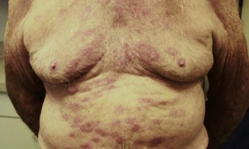 По 30 години во Хрватска потврден случај на лепра кај странски работник