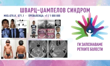 „Ги запознаваме ретките болести“: Шварц-џампелов синдром/Хондродистрофична миотонија/SCHWARTZ–JAMPEL SYNDROME