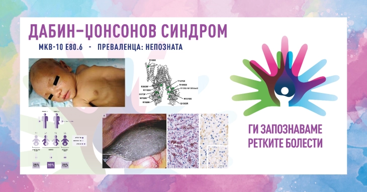 „Ги запознаваме ретките болести“: Дабин-џонсонов синдром