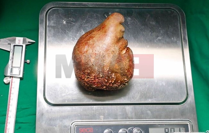 Истражување: Научници открија бактерии во бубрежни камења