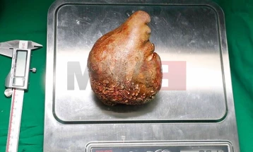 Истражување: Научници открија бактерии во бубрежни камења