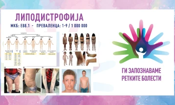 „Ги запознаваме ретките болести“: Липодистрофија