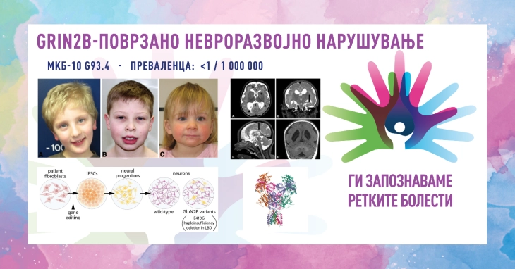 „Ги запознаваме ретките болести“: GRIN2B-поврзано невроразвојно нарушување