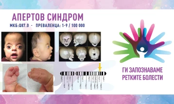 „Ги запознаваме ретките болести“: Апертов синдром