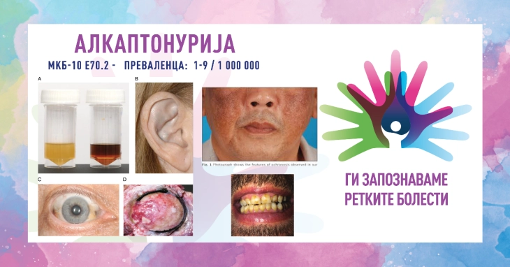 „Ги запознаваме ретките болести“: Алкаптонурија/болест на црна урина