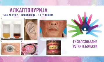 „Ги запознаваме ретките болести“: Алкаптонурија/болест на црна урина