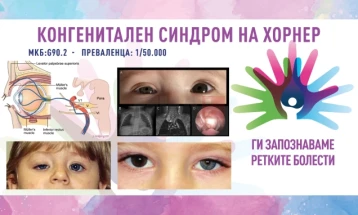 T'i njohim sëmundjet e rralla 2026