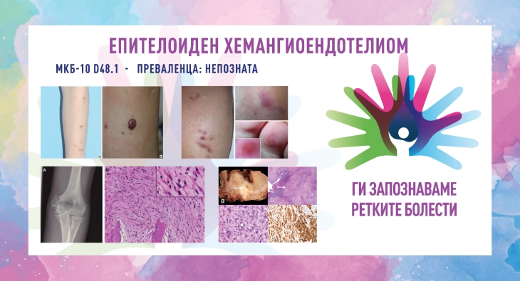 „Ги запознаваме ретките болести“: Епителоиден хемангиоендотелиом