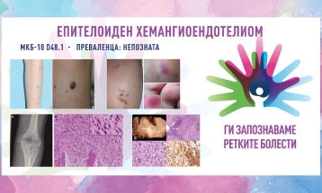 „Ги запознаваме ретките болести“: Епителоиден хемангиоендотелиом