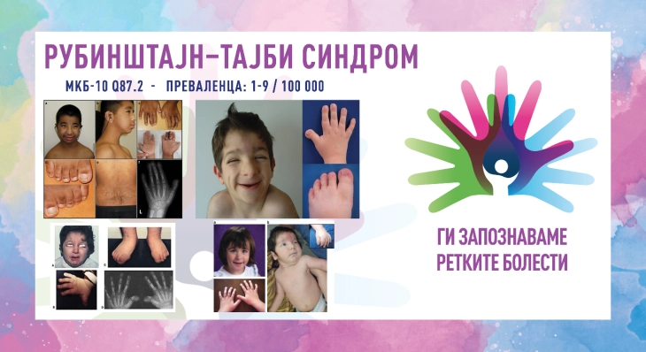 „Ги запознаваме ретките болести“: Рубинштајн–Тајби синдром