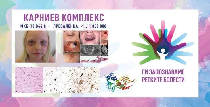 „Ги запознаваме ретките болести“: Карниев комплекс/Бенигна неоплазма на ендокрините жлезди