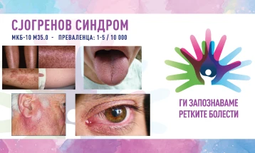 „Ги запознаваме ретките болести“: Сјогренов синдром