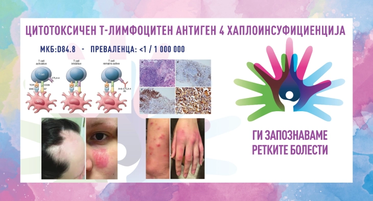 „Ги запознаваме ретките болести“: Цитотоксичен т-лимфоцитен антиген 4 хаплоинсуфициенција