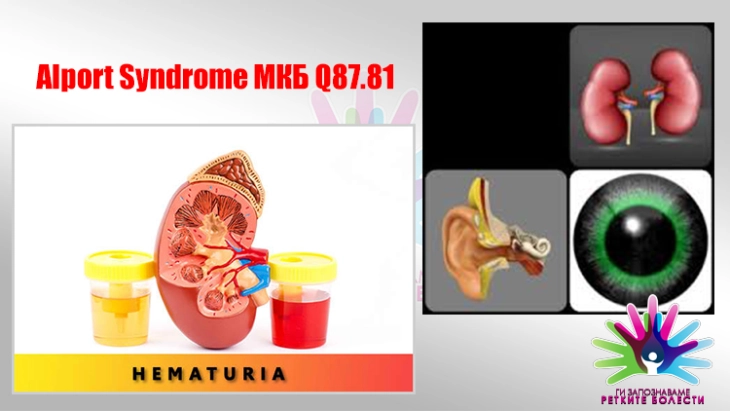 Ретки бубрежни болести: Алпортов синдром